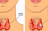 甲状结节一览表（甲状结节的位置在哪里）