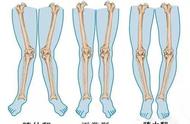 x型腿判断标准图（xo型腿怎么矫正最有效）
