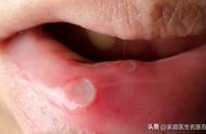 口腔溃疡发病的七大原因（口腔溃疡发病治疗方法）