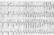 尖端扭转型室速原因（尖端扭转型室速治疗绝对禁忌）