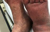 老人右脚肿是什么病的前兆（90岁老人脚肿能活多久）