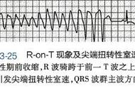 尖端扭转型室速解决方法（尖端扭转型室速是多源性室速吗）