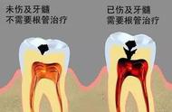 根管治疗不做牙冠能维持多久（根管治疗后一年还能做牙冠么）