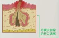 戴两天口罩脸上长痘痘什么原因（老戴口罩脸上出了好多痘痘怎么办）