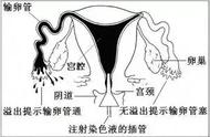 输卵管造影全过程图解（输卵管造影检查具体步骤图片）