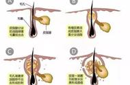 鼻贴膜捏碎了还能用吗（鼻贴膜怎么用最有效）