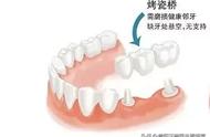镶牙后牙疼的正确处理方法图（镶牙后一般要疼几天）