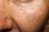 皮肤粗糙毛孔大是什么原因（皮肤粗糙是什么原因造成的）