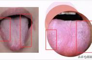 舌根瘀点的图片（舌头瘀斑瘀点图片）