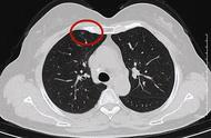 混杂磨玻璃结节是肺癌早期吗（混合磨玻璃结节20年了）