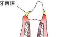 可以长期用纳米牙刷吗（纳米牙刷多久换一个）