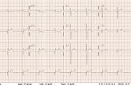 心电图发现异常Q波需要做进一步检查吗?（心电图q波异常怎么治疗）