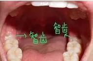 拔智齿的好处和坏处（为什么说拔智齿伤元气）