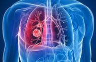 结缔组织病肺间质纤维化不良后果（结缔组织病肺间质纤维化能活多久）