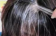 叶酸片能治白头发吗（吃什么白发变黑发最快最好）