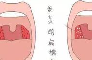 喉咙扁桃体肿大图片高清图片大全（成年人扁桃体肿大图片）