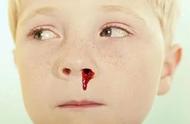 儿童半夜流鼻血的原因（孩子半夜流鼻血怎么办）