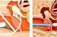 耳耵聍是什么原因引起的（耳耵聍是什么原因引起的怎么治疗）