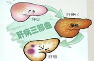 肝硬化需要忌房吗（肝硬化晚期十大忌口）