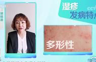 容易长痱子是缺乏什么（为什么会特别容易起痱子）