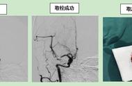 左侧顶叶脑梗塞能康复吗（右侧顶叶脑梗塞能治愈吗）