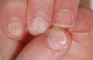 婴儿指甲盖有横条纹（婴儿指甲横条纹是什么原因）