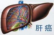 晚期肝癌不建议治疗（肝癌晚期死前4个信号）