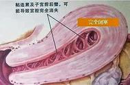 人工流产半月来例假正常吗（人工流产半个月就来月经了正常吗）