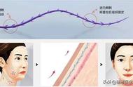 线雕提升一次能维持多久（线雕10年后遗症图）