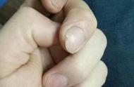 小指疼痛是什么病兆（小手指疼痛预示着三种病）