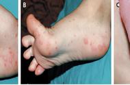 手足口病的症状和治疗方法（一招辨认手足口照片）