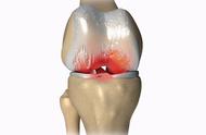 十大伤膝盖的运动（六种保护膝盖的运动）