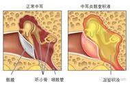 咽鼓管解剖位置图（咽鼓管在耳部开口位置图片）