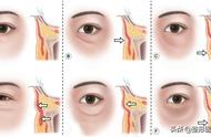 下眼睑凹陷黑眼圈图片（凹陷性黑眼圈图片）