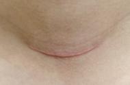 甲状旁腺手术刀口照片（甲状腺手术引流管图片）