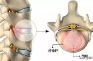 微创治腰间盘突出的最好方法（理疗治疗腰间盘突出的最佳方法）