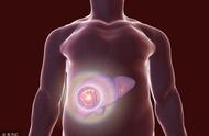 胆管癌和肝癌的关系（一般胆管癌并发肝癌）