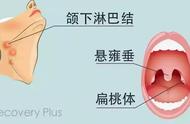 正常扁桃体和发炎图片 肿大（扁桃体一直肿大不消图片）