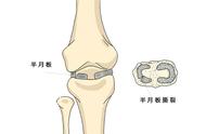 半月板撕裂最佳自愈方法（半月板损伤膝盖疼的最好治疗方法）