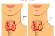 甲状腺结节图片（甲状腺结节的脖子和正常脖子图片）