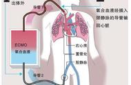 人工肺可以代替肺吗（用了人工肺还能像正常人一样吗）