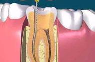 牙本质暴露需要根管治疗吗（根管治疗最痛苦的一步）