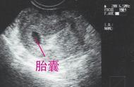 怀孕4个月胎儿b超图，怀孕四个月胎儿肚子b超图