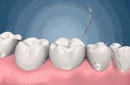 全口牙制作方法（口内临时牙的制作步骤）