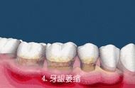 怎样保护牙龈不萎缩（怎样做能防止牙龈继续萎缩）