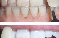 牙齿贴面可以保持多久（牙齿贴面能维持几十年吗）