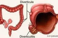 结肠憩室形成的原因（结肠憩室怎么治疗最好）