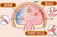 老公中风三年多（面瘫一般多久恢复正常）