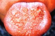 舌根苔示意图（舌根疾病与症状图解）