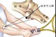 网球肘的正确诊断图解（网球肘疼痛位置示意图和作用）